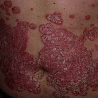 best skin doctors in delhi,psoriasis treatment in delhi,best dermatologist in delhi